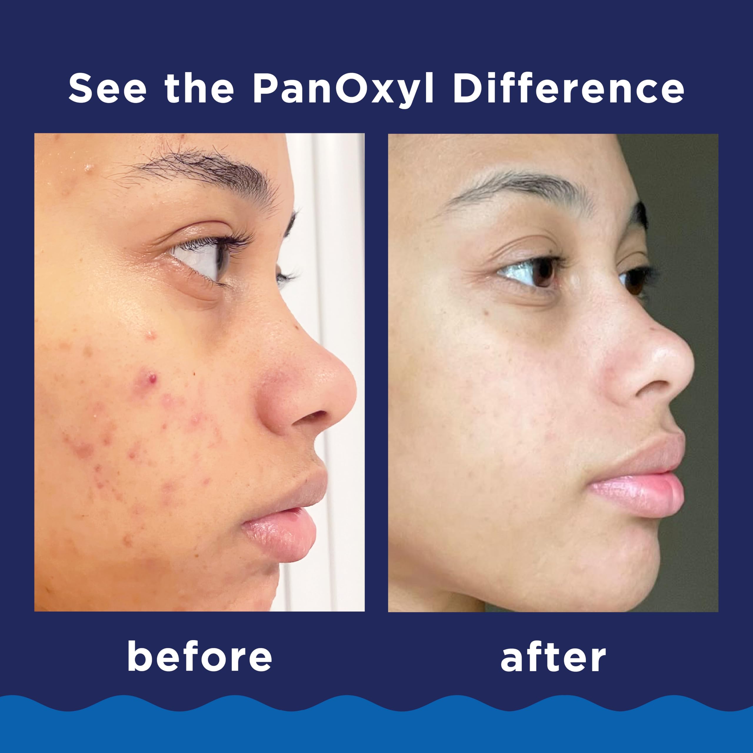 Foto 5 pulgar | Limpiador Facial Panoxyl Acne Foaming Con Peróxido De Benzoilo 10% 90 Ml - Venta Internacional.