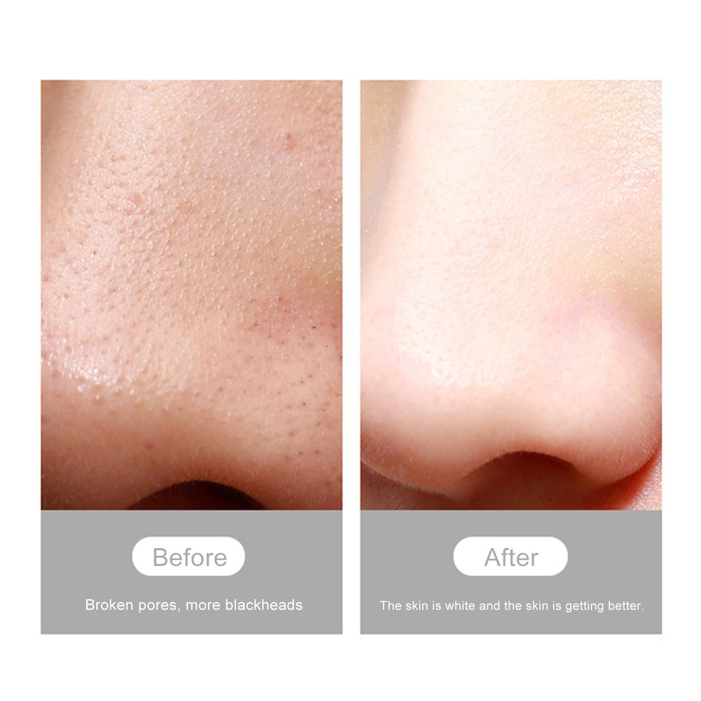Foto 5 pulgar | Limpiador Facial y Aspiradora de Poros con Cámara - Venta Internacional