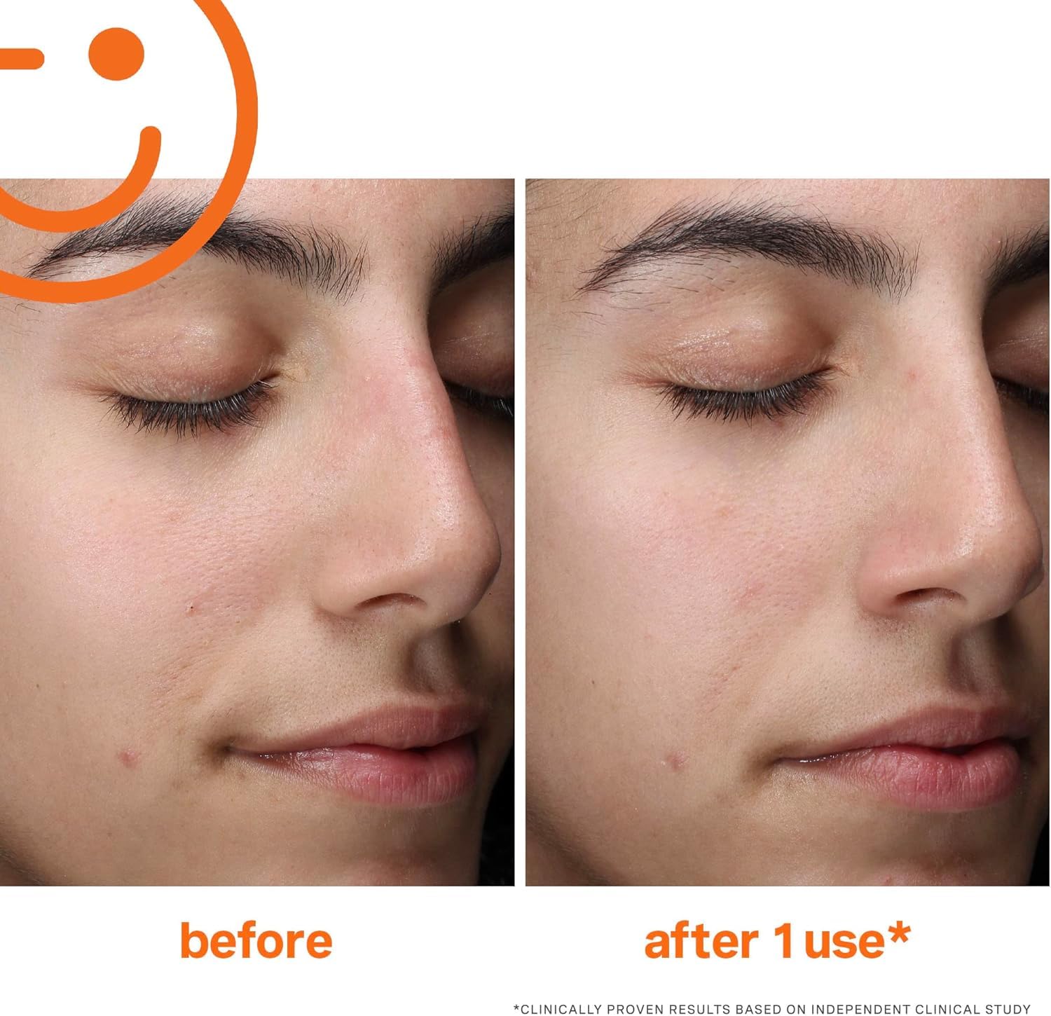 Foto 6 pulgar | Limpiador Facial Kate Somerville Exfolikate De 50 Ml Con Aha - Venta Internacional.