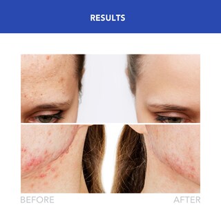 Foto 4 | Dispositivo De Luz Led Foreo Espada 2 Para Tratamiento De Imperfecciones, Color Azul - Venta Internacional.
