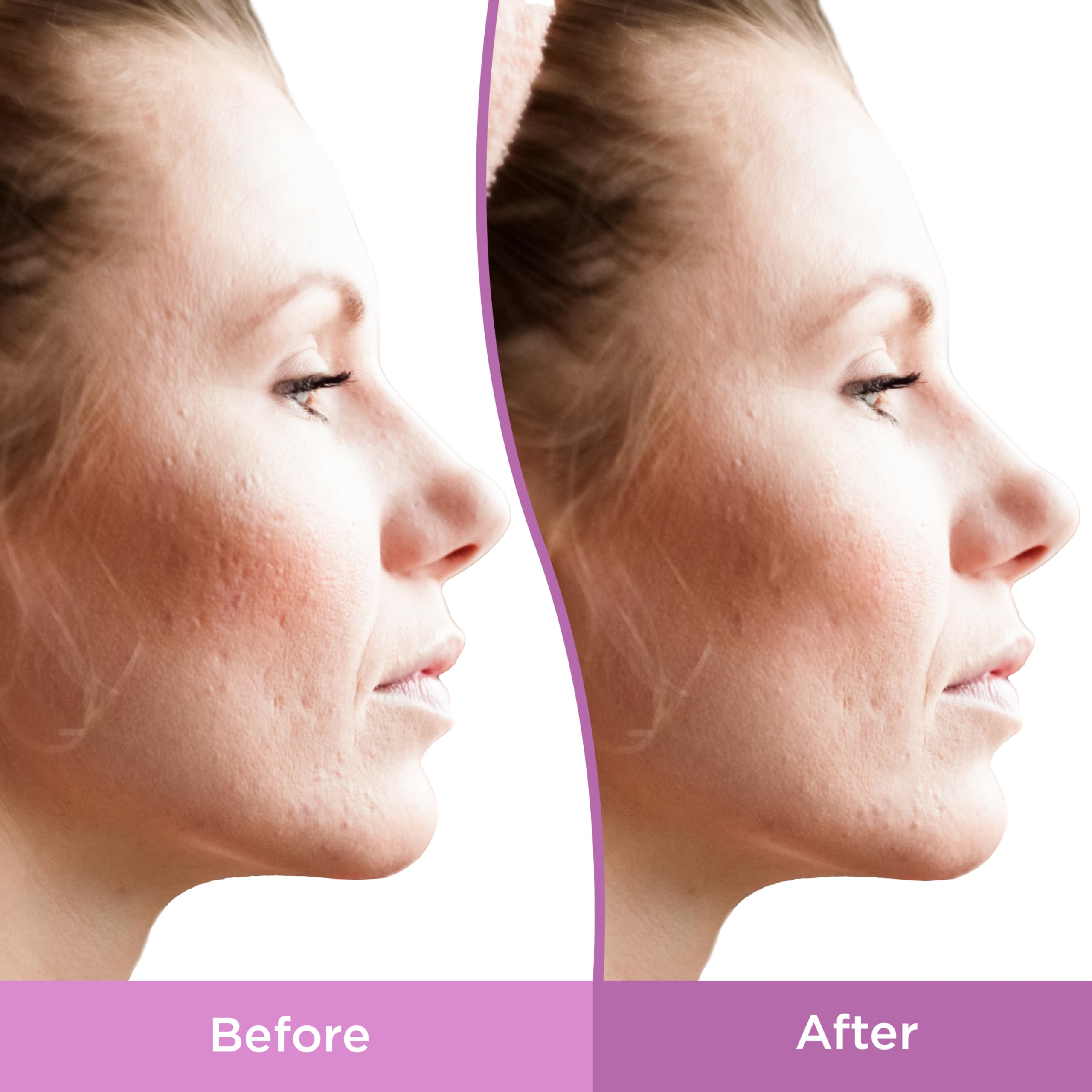 Foto 6 pulgar | Gel Differin Para Tratamiento Facial De Manchas Y Cicatrices De Acné, 30 Ml - Venta Internacional.