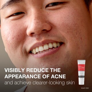 Foto 3 | Gel Neutrogena Rapid Clear Para Tratar Las Manchas Del Acné, 30 Ml, 10% Bp - Venta Internacional.
