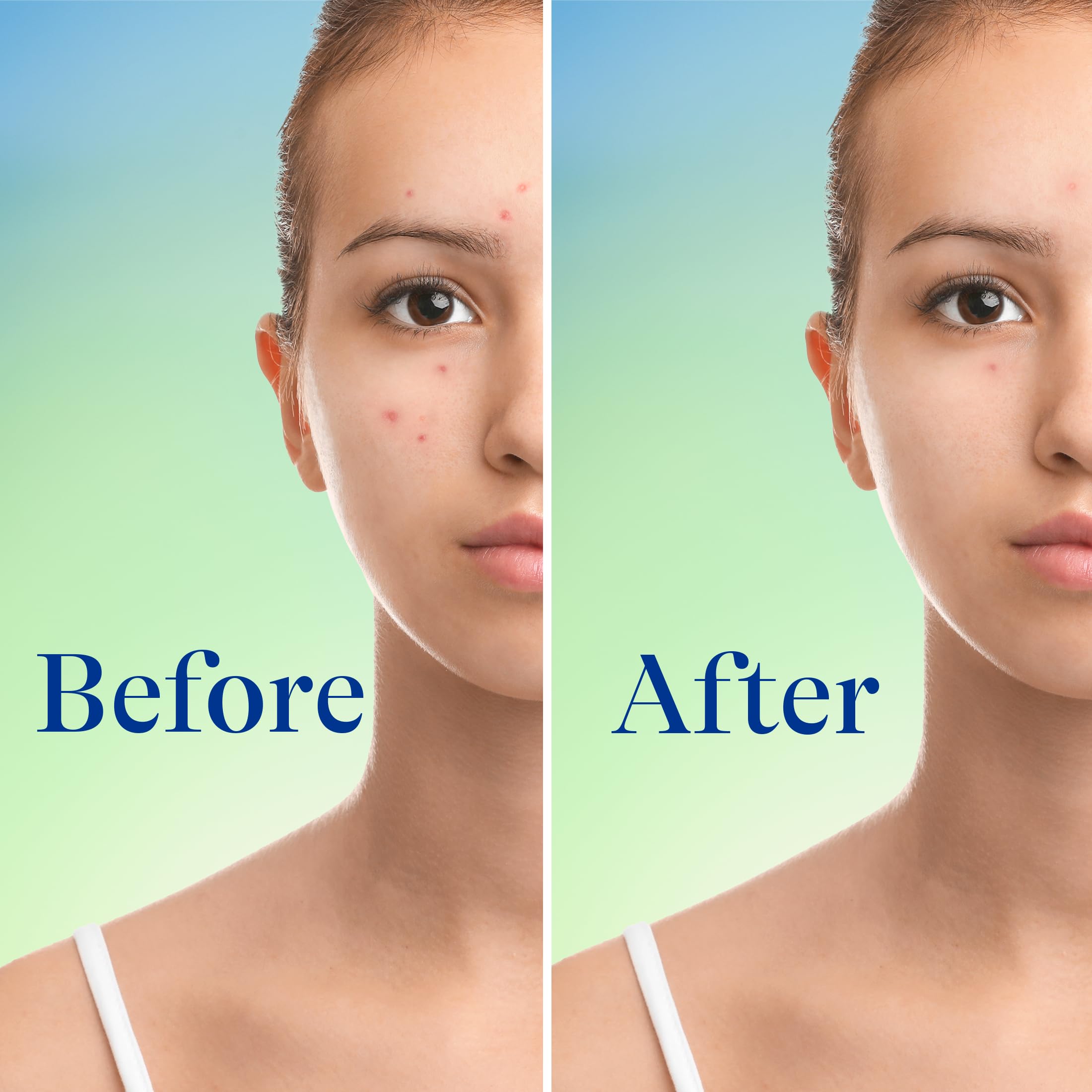 Foto 7 pulgar | Jabón Facial Differin con Peróxido de Benzoilo al 10% 148 ml - Venta Internacional