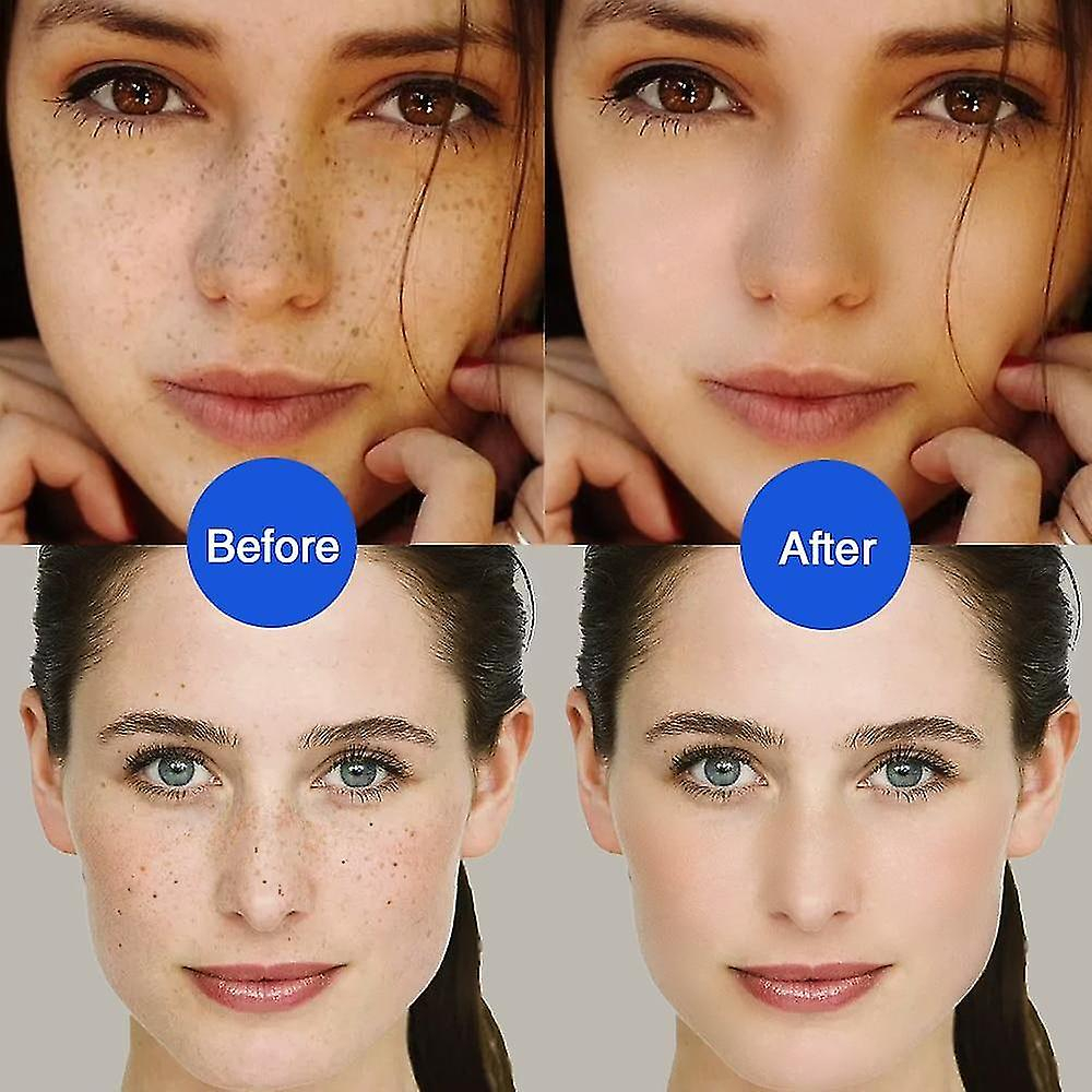 Foto 5 | Limpiadores Faciales Con Bolígrafo Lcd Sweep Spot  Eliminación Láser De Lunares Y Tatuajes - Venta Internacional.