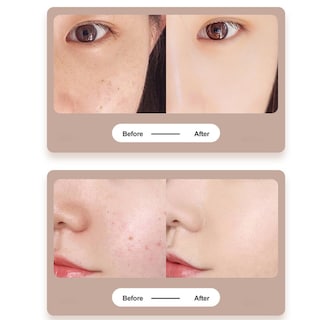 Foto 3 | Lápiz De Plasma Para Tatuaje De Lunares Pecas Y Verrugas Color Dorado - Venta Internacional.