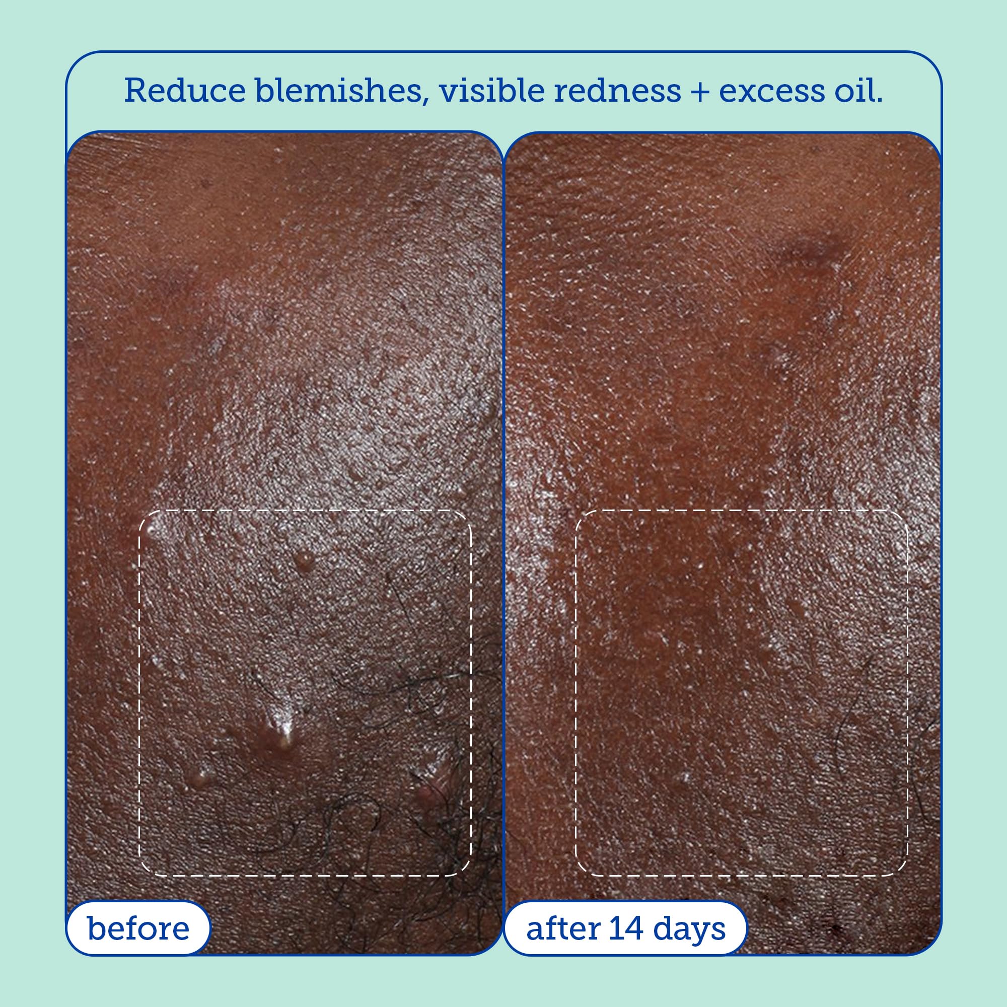Foto 4 pulgar | El Limpiador Skinfix Acne+ Bha 150 Ml Reduce Las Imperfecciones Y El Exceso De Grasa - Venta Internacional.