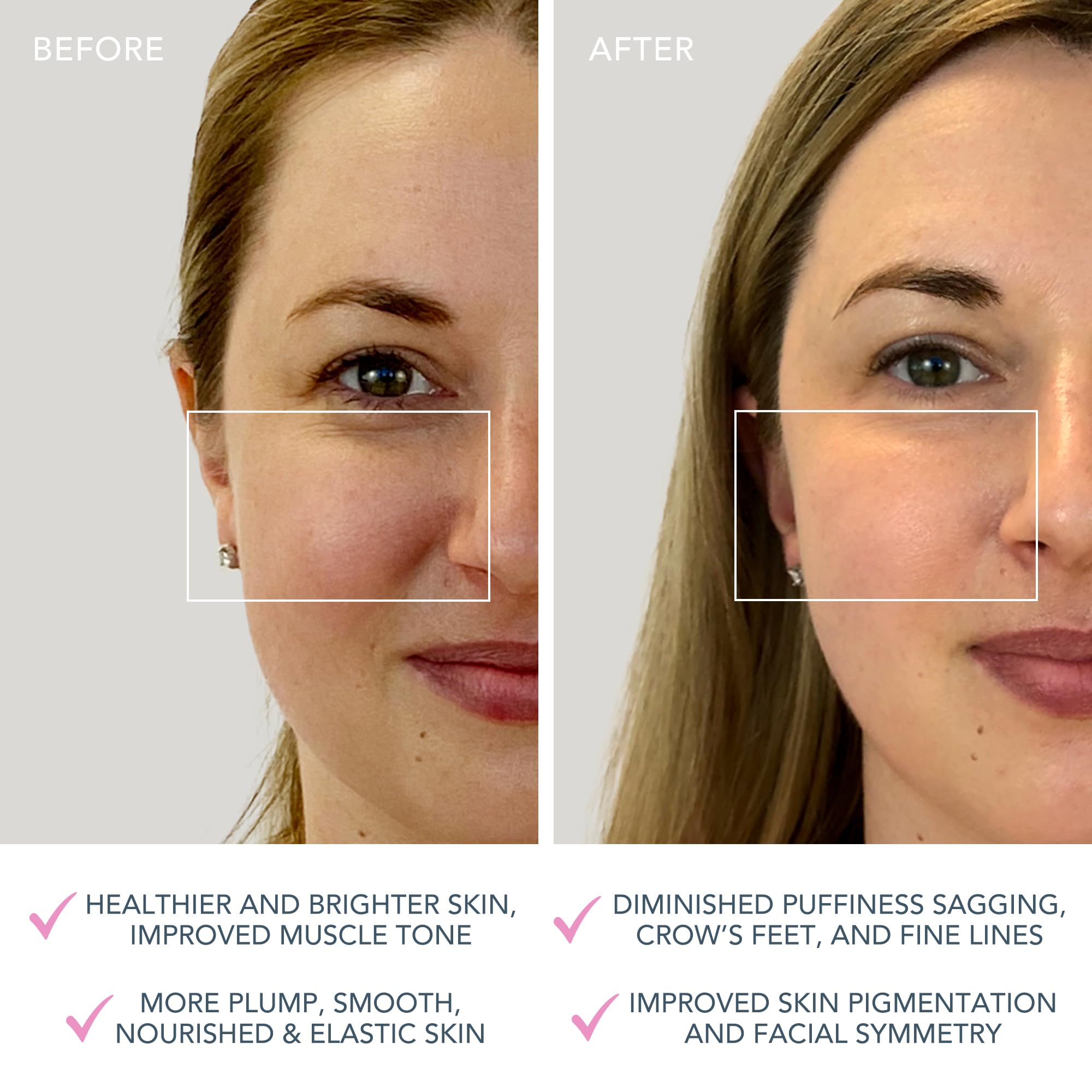 Foto 6 pulgar | Dispositivo Facial Foreo Bear Mini Para Esculpir La Cara Con Microcorriente - Venta Internacional.