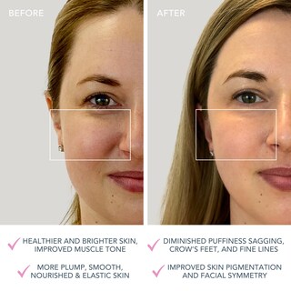 Foto 5 | Dispositivo Facial Foreo Bear Mini Para Esculpir La Cara Con Microcorriente - Venta Internacional.