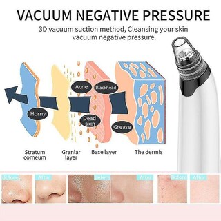 Foto 2 | Limpiador Facial Para Eliminar Puntos Negros Con Succión Al Vacío Para Acné - Venta Internacional.