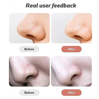Foto 2 | Limpiador Facial Eliminador De Puntos Negros Huoguo Vacuum Suction - Venta Internacional.
