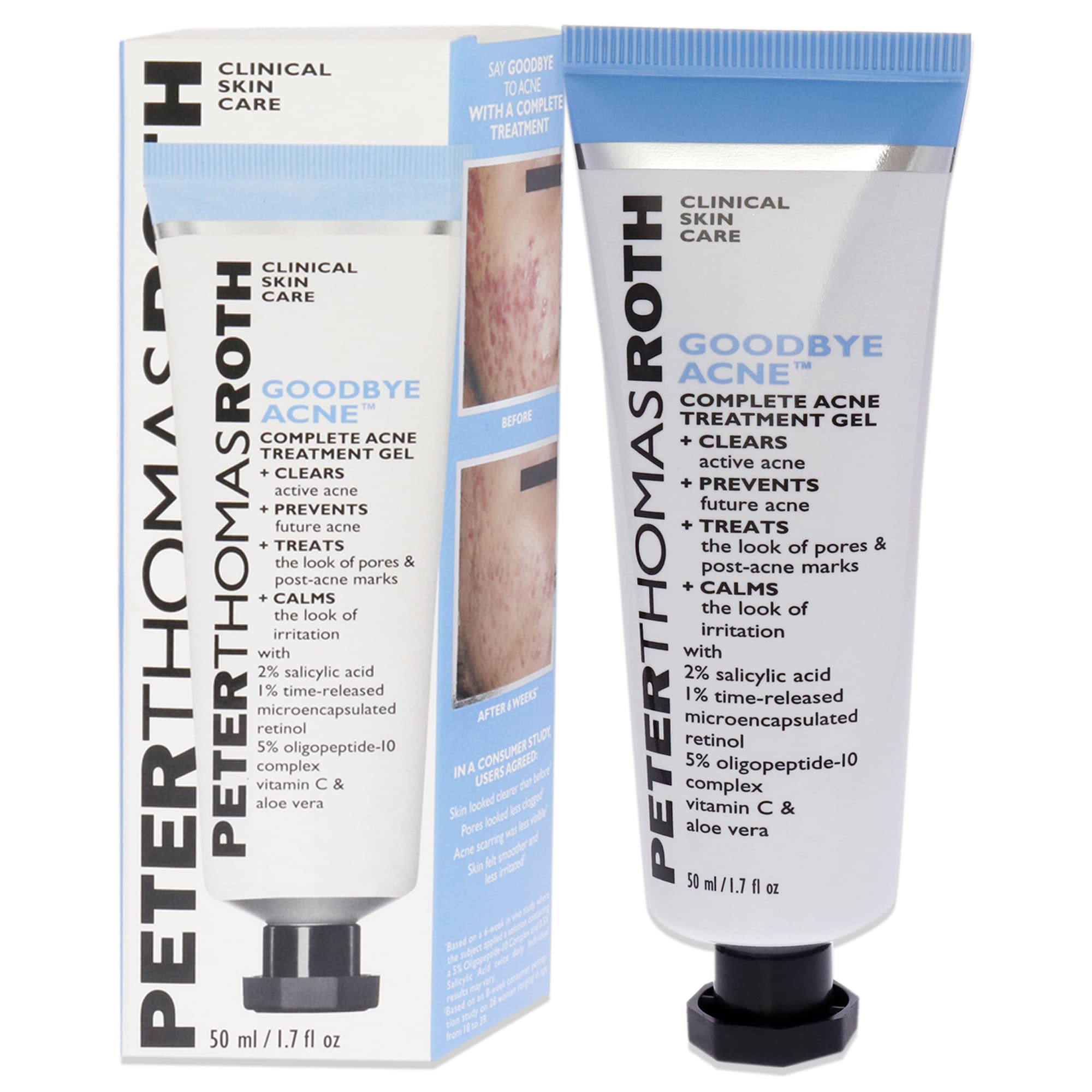 Gel De Tratamiento Del Acné Peter Thomas Roth Adiós Al Acné - Venta Internacional.