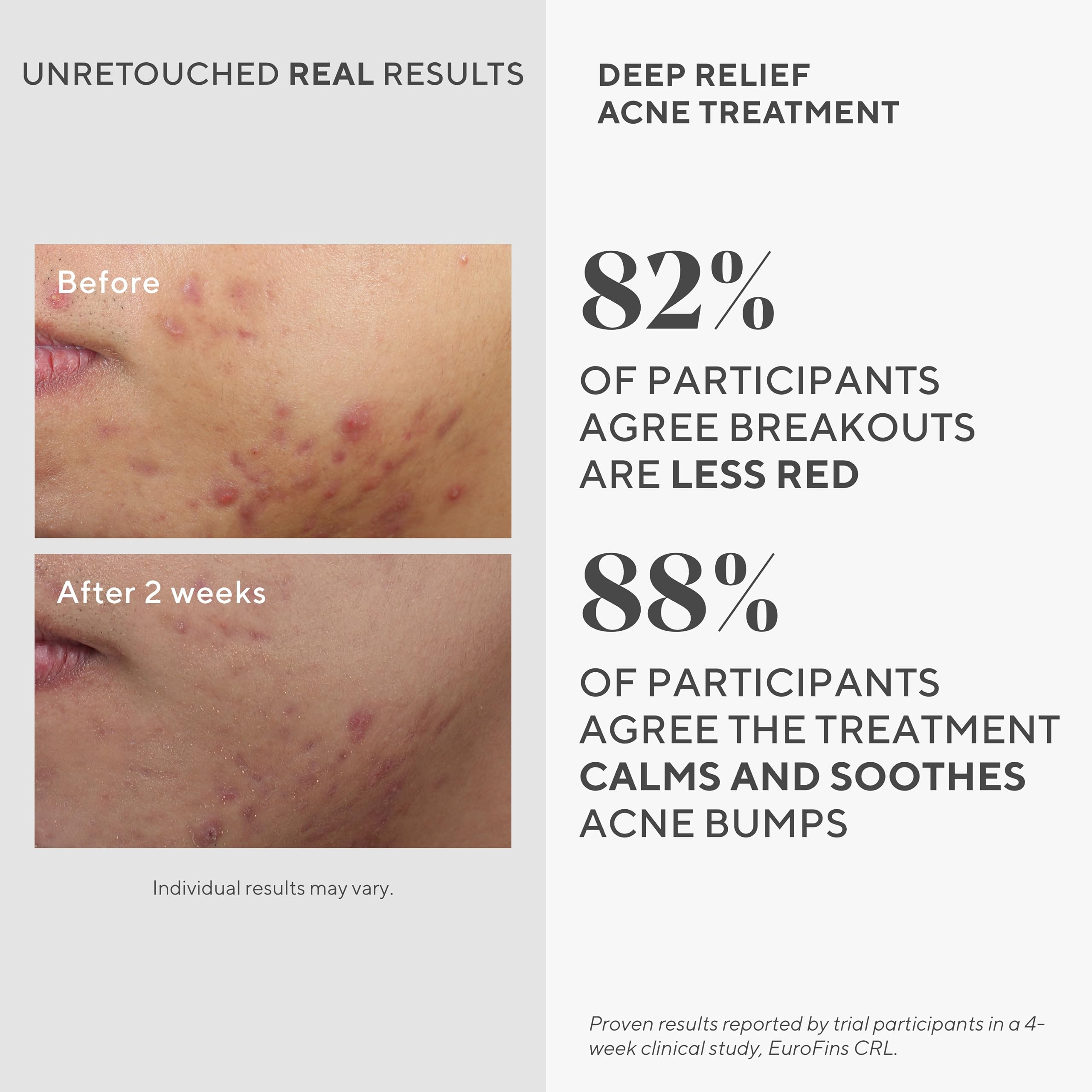 Foto 5 pulgar | Tratamiento Para El Acné Murad Deep Relief Acne Control, 30 Ml, 2% De Ácido Salicílico - Venta Internacional.