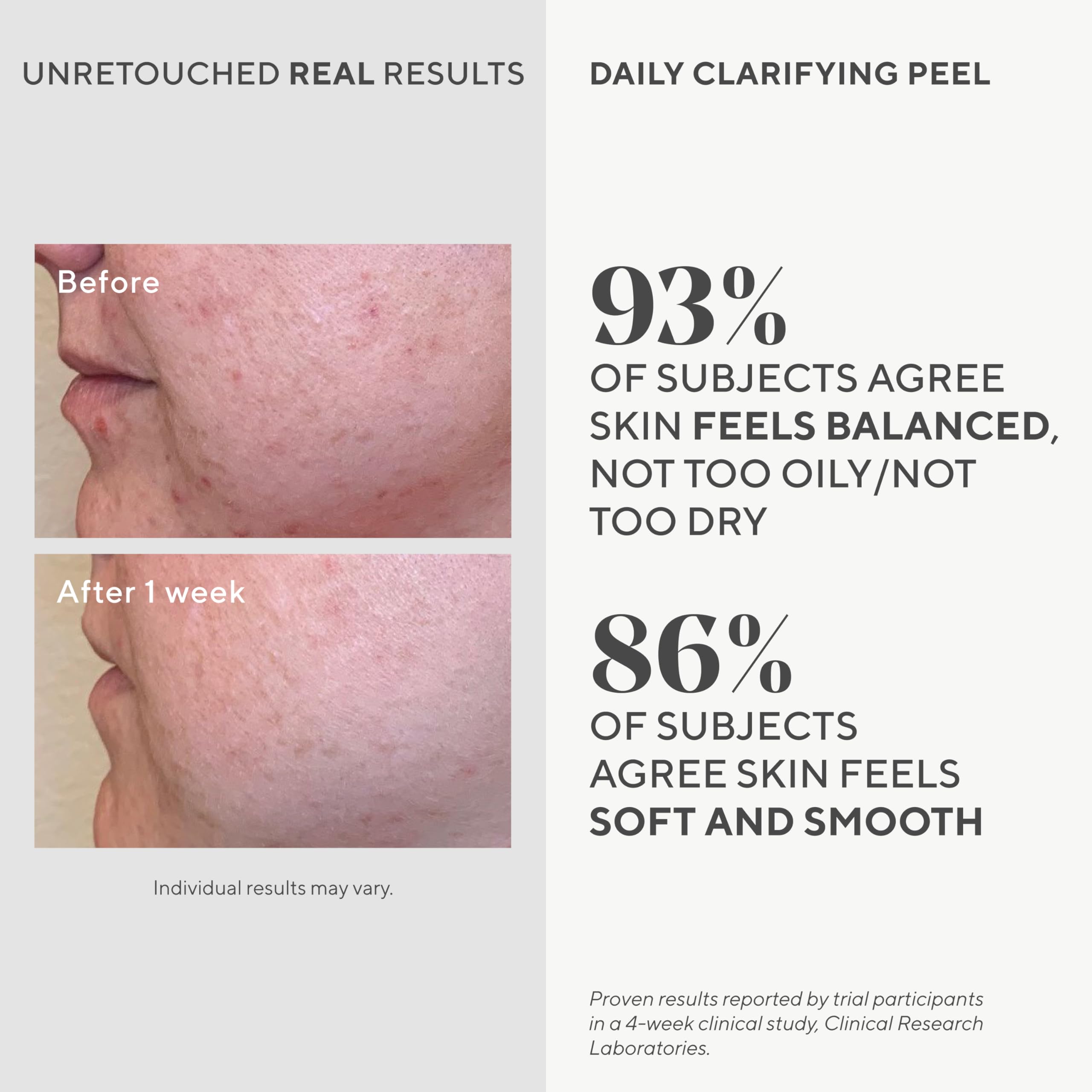 Foto 4 pulgar | Solución Exfoliante Murad Daily Clarifying Retinoide Rejuvenecedor 100 Ml - Venta Internacional