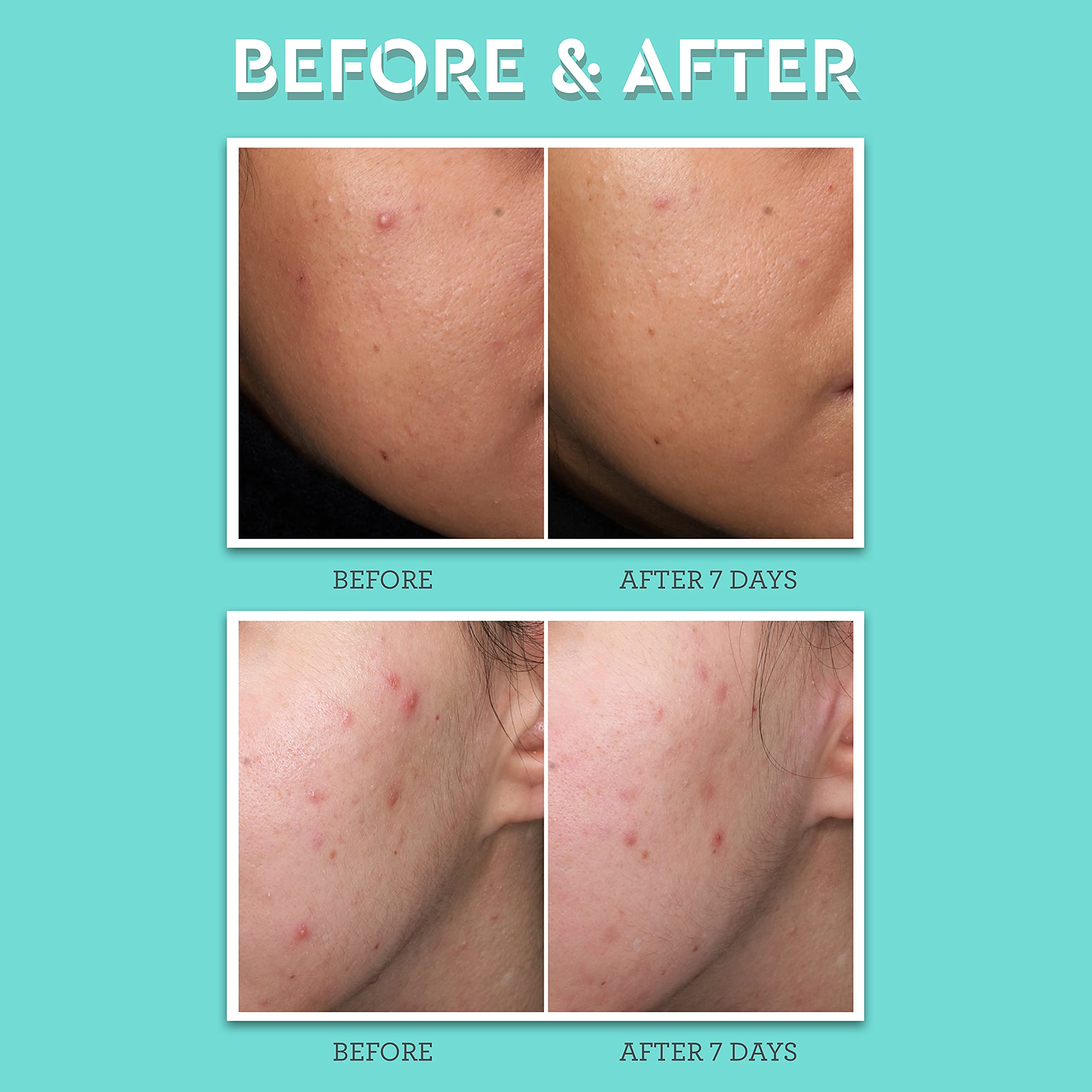Foto 4 | Tratamiento Para Manchas De Acné Bliss Clear Genius Con Ácido Salicílico Al 2% - Venta Internacional.