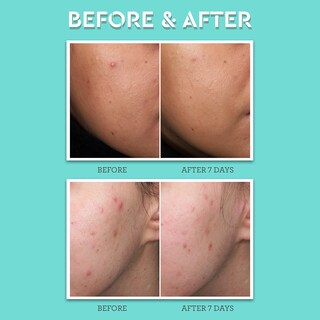 Foto 4 | Tratamiento Para Manchas De Acné Bliss Clear Genius Con Ácido Salicílico Al 2% - Venta Internacional.