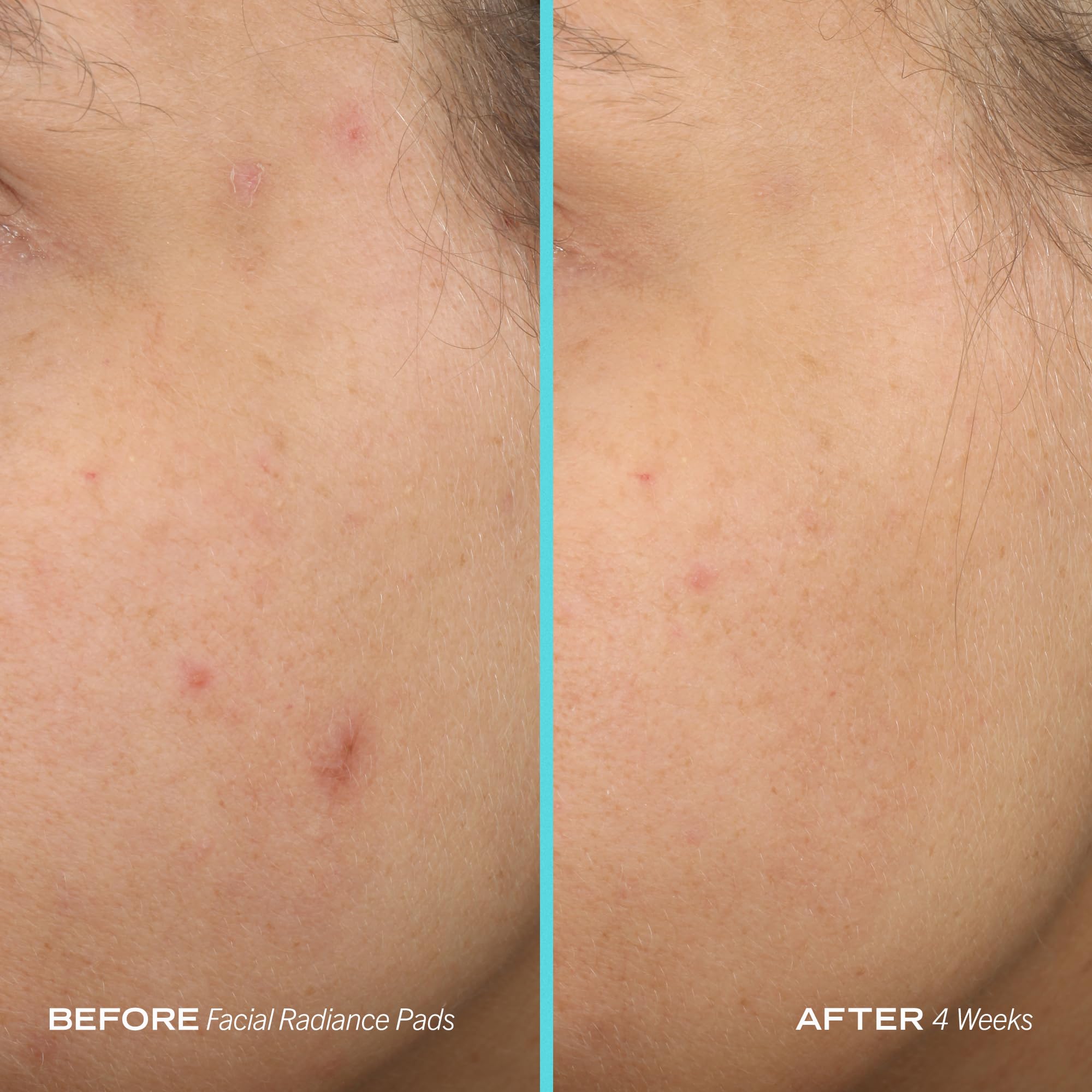 Foto 8 pulgar | Almohadillas Exfoliantes First Aid Beauty Facial Radiance, 28 Almohadillas - Venta Internacional.