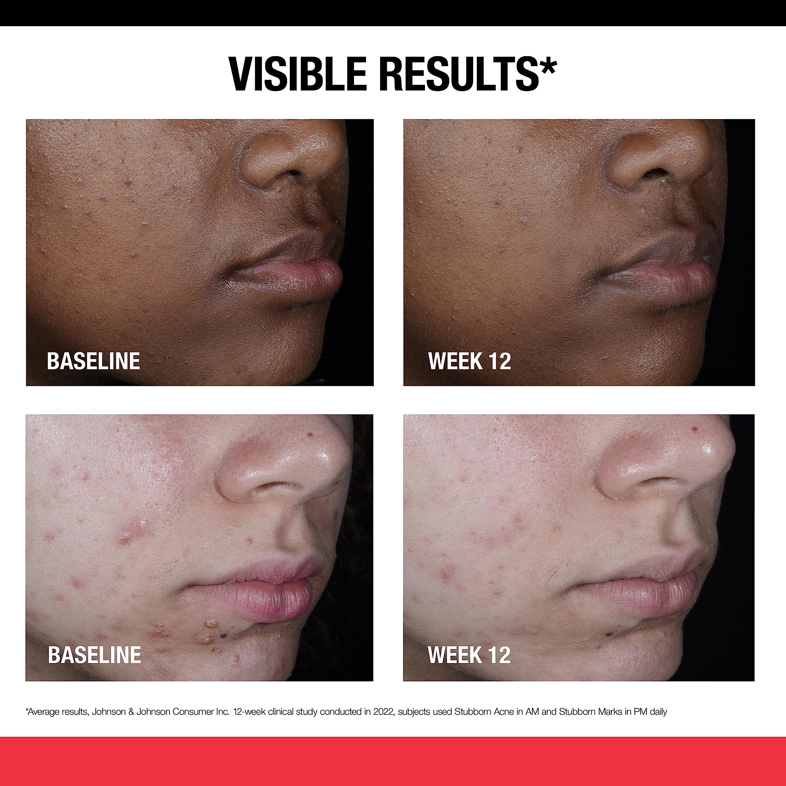 Foto 6 pulgar | Tratamiento Neutrogena Stubborn Marks Pm Retinol 30 Ml - Venta Internacional.