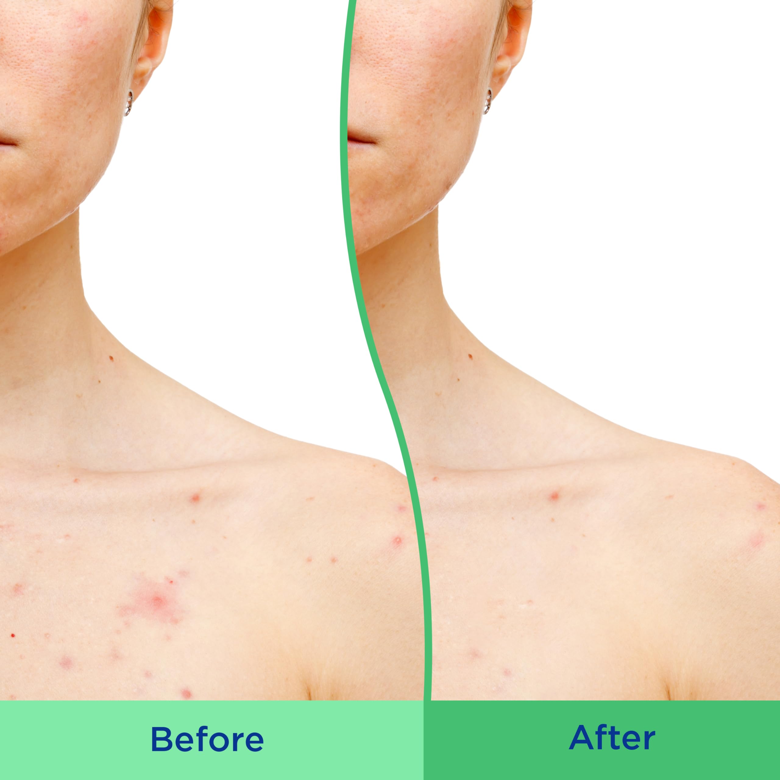 Foto 6 pulgar | Exfoliante Corporal Differin Con Ácido Salicílico Para Eliminar El Acné 240 Ml - Venta Internacional.
