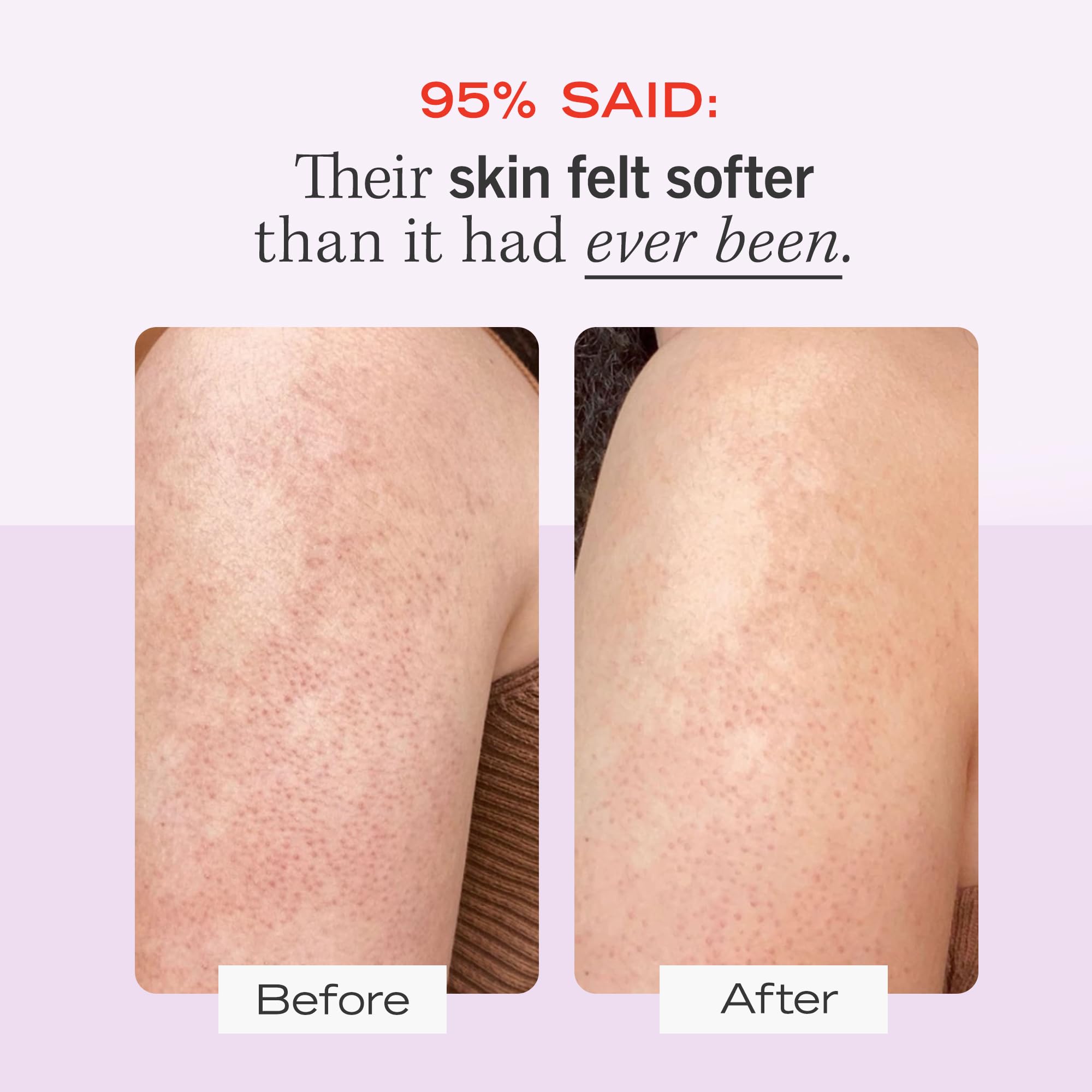 Foto 4 pulgar | Exfoliante Corporal First Aid Beauty Kp Bump Eraser 120 Ml 10% Aha - Venta Internacional.