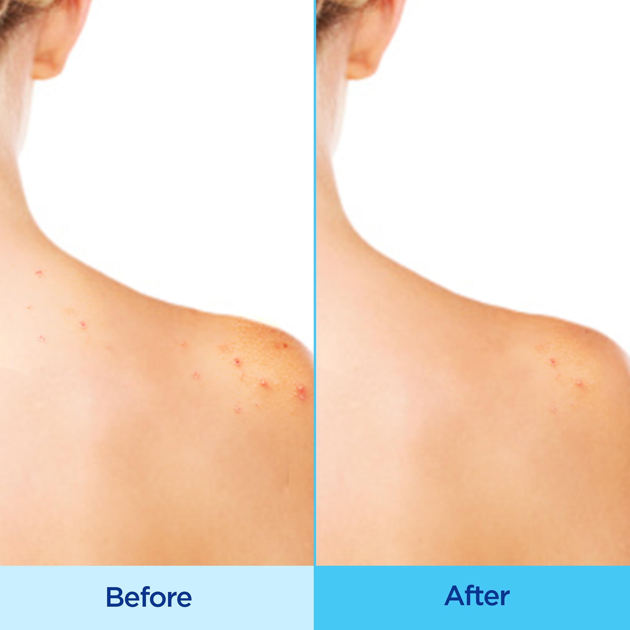 Foto 3 | Spray Corporal Para El Acné Differin 360 Con Ácido Salicílico 180 Ml - Venta Internacional.