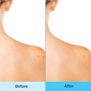 Foto 3 | Spray Corporal Para El Acné Differin 360 Con Ácido Salicílico 180 Ml - Venta Internacional.