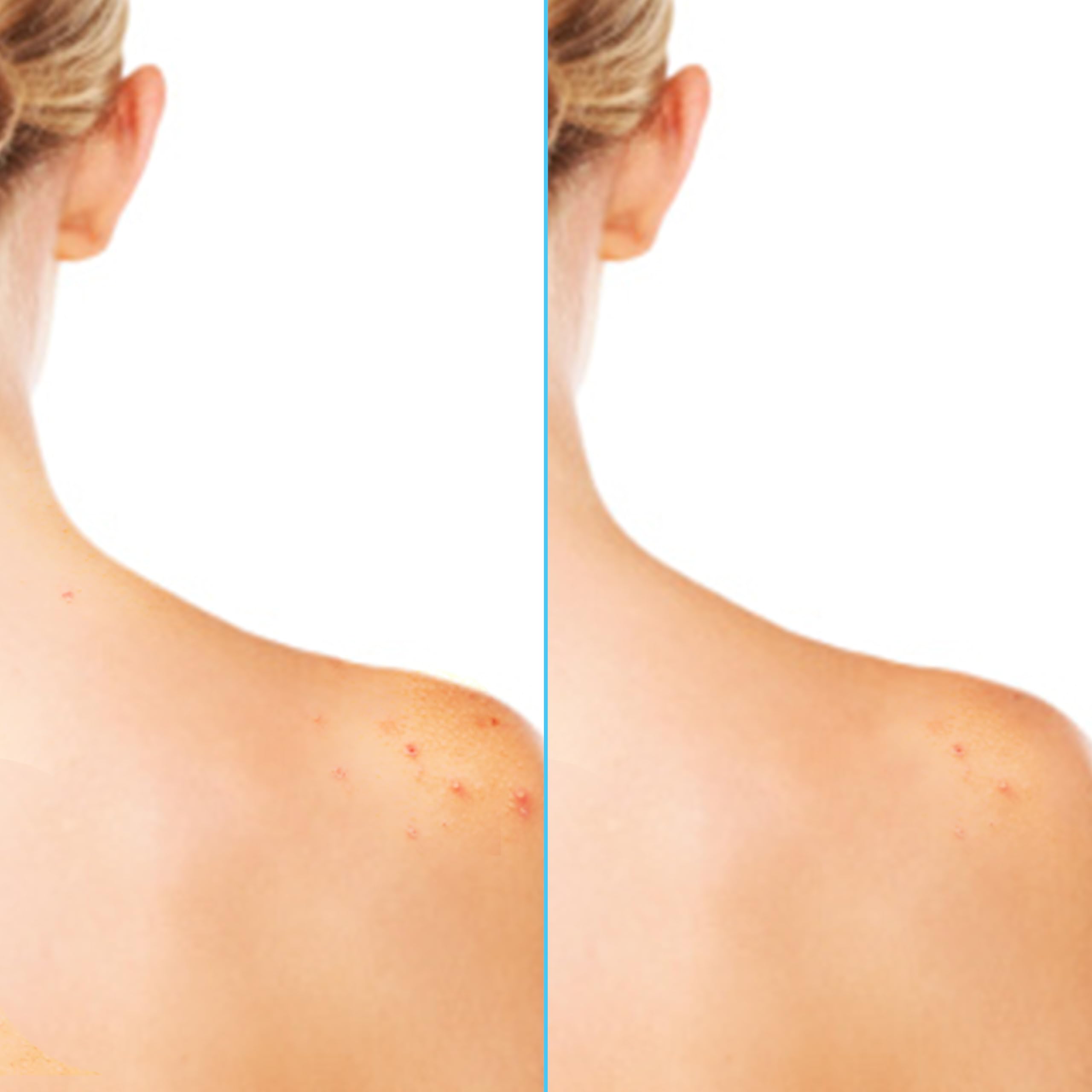 Foto 7 | Spray Corporal Para El Acné Differin 360 Con Ácido Salicílico 180 Ml - Venta Internacional.