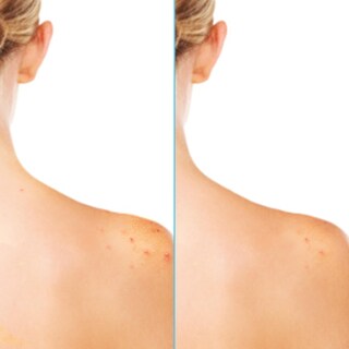Foto 7 | Spray Corporal Para El Acné Differin 360 Con Ácido Salicílico 180 Ml - Venta Internacional.