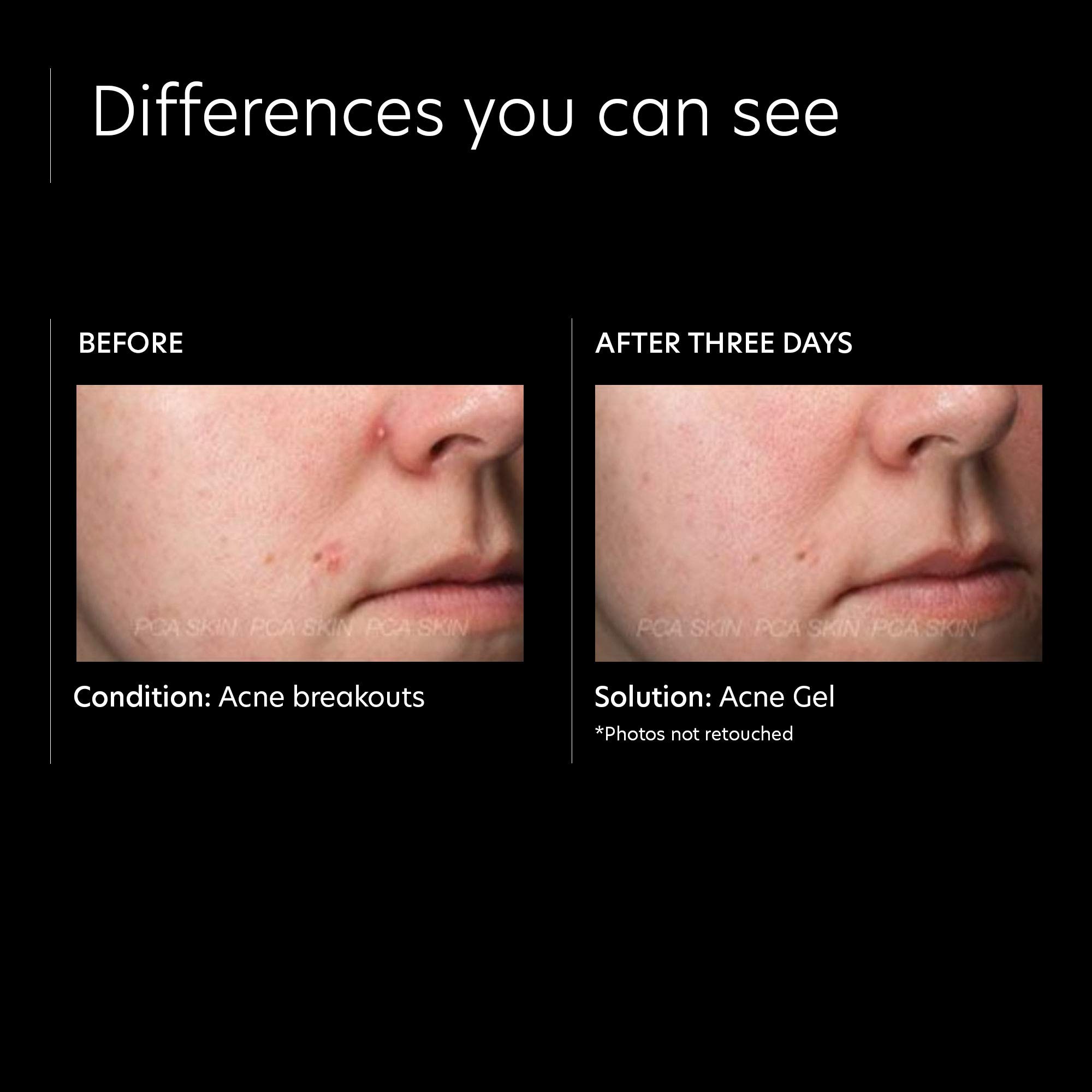 Foto 4 | Gel Para El Acné Pca Skin Tratamiento Para Manchas De Acné Con 2% De Ácido Salicílico, 30 Ml - Venta Internacional.