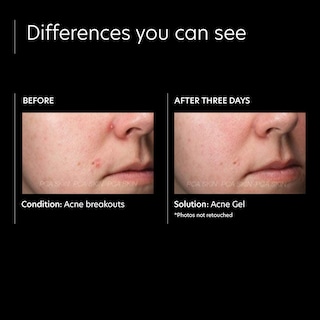 Foto 4 | Gel Para El Acné Pca Skin Tratamiento Para Manchas De Acné Con 2% De Ácido Salicílico, 30 Ml - Venta Internacional.