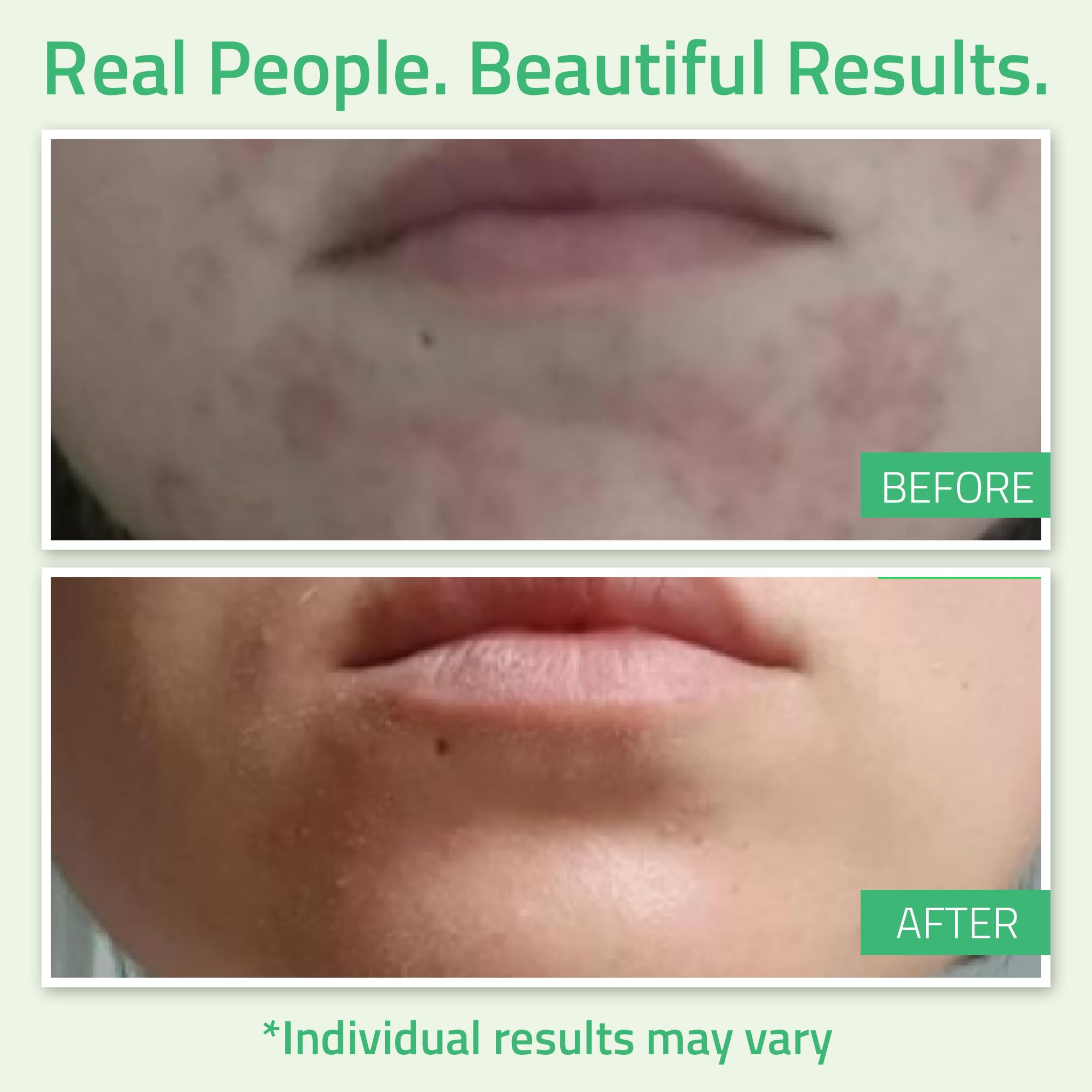 Foto 5 pulgar | Exfoliante Casero Con Ácido Glicólico Peel Yeouth, 30% Aha, 30 Ml Con Retinol - Venta Internacional.