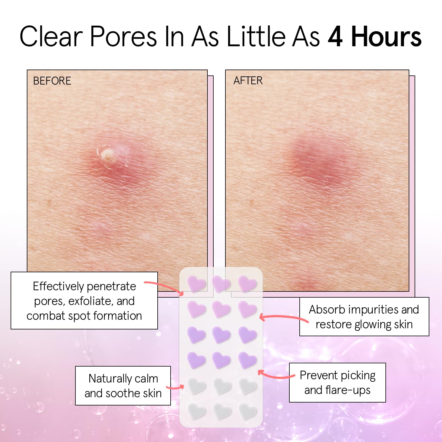 Foto 4 pulgar | Pimple Patches Grace & Stella Heart Hydrocoloid Zit  36 Unidades - Venta Internacional.