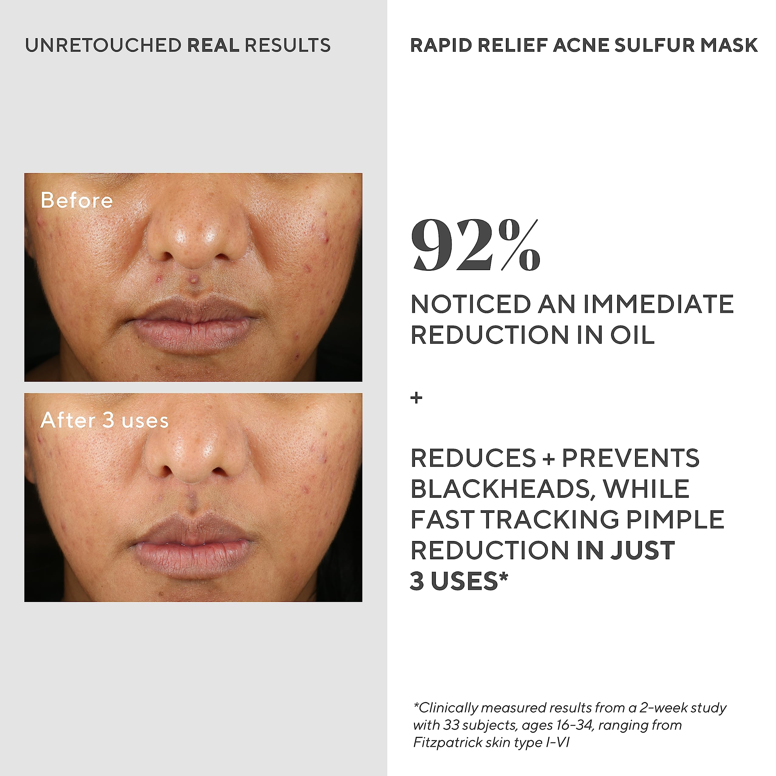 Foto 5 pulgar | Mascarilla Facial De Arcilla Murad Rapid Relief Acne Sulfur Con Ácido Salicílico - Venta Internacional.