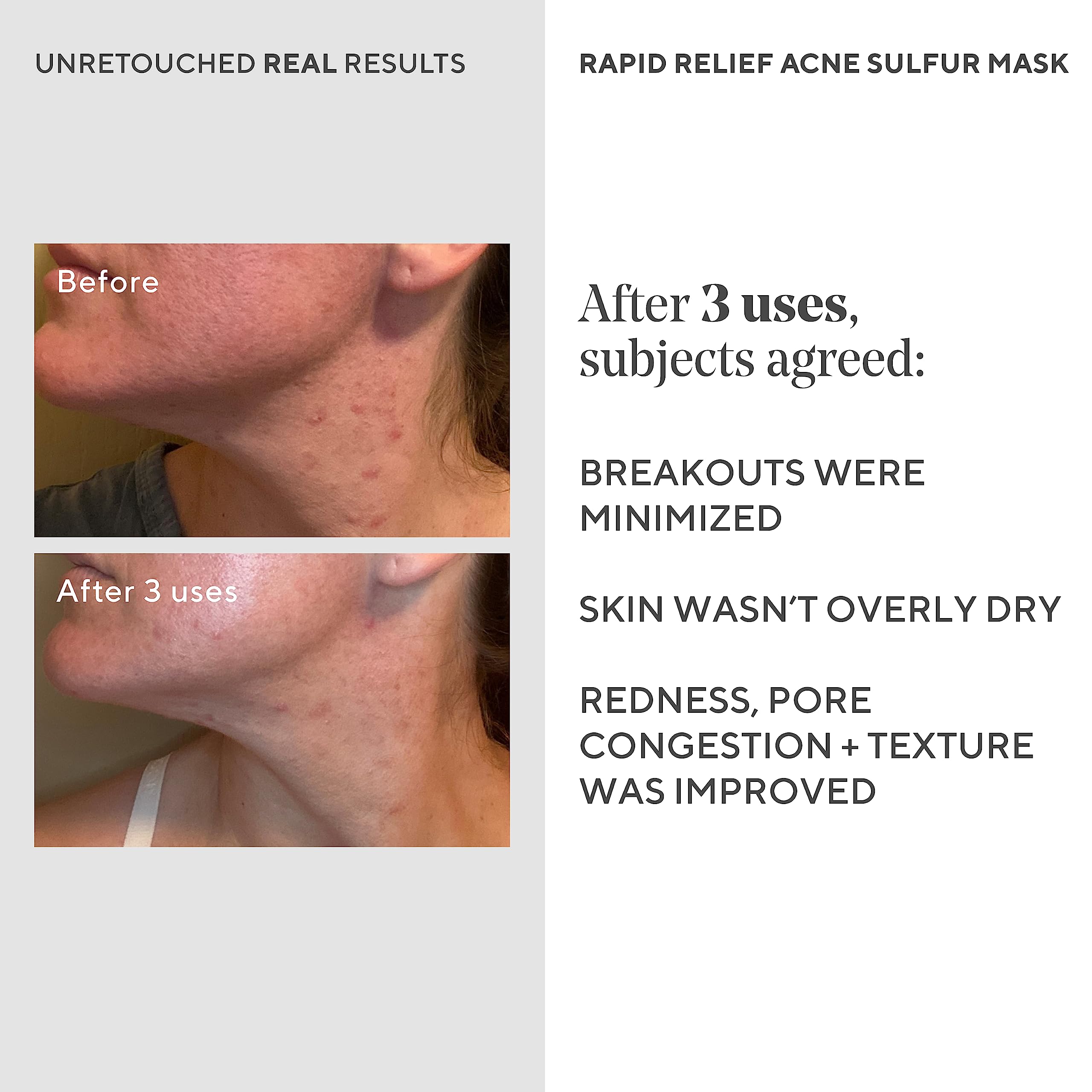 Foto 6 pulgar | Mascarilla Facial De Arcilla Murad Rapid Relief Acne Sulfur Con Ácido Salicílico - Venta Internacional.