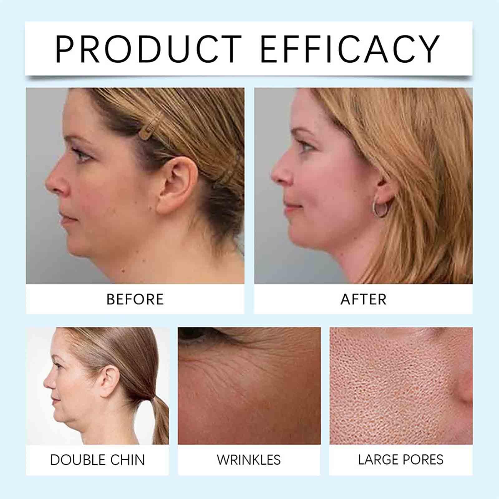 Foto 5 pulgar | Mascarilla Chinology Chin Lifting Con Ácido Hialurónico, 5 Unidades - Venta Internacional.