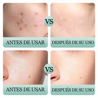 Foto 4 | Set 5 Mascarilla Negra Facial Bambu Elimina Puntos Negros Nariz