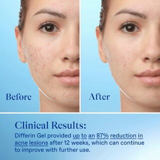Foto 7 | Gel Para Tratamiento Del Acné Differin 0,1% De Adapaleno, 15 G, Suministro Para 30 Días - Venta Internacional.