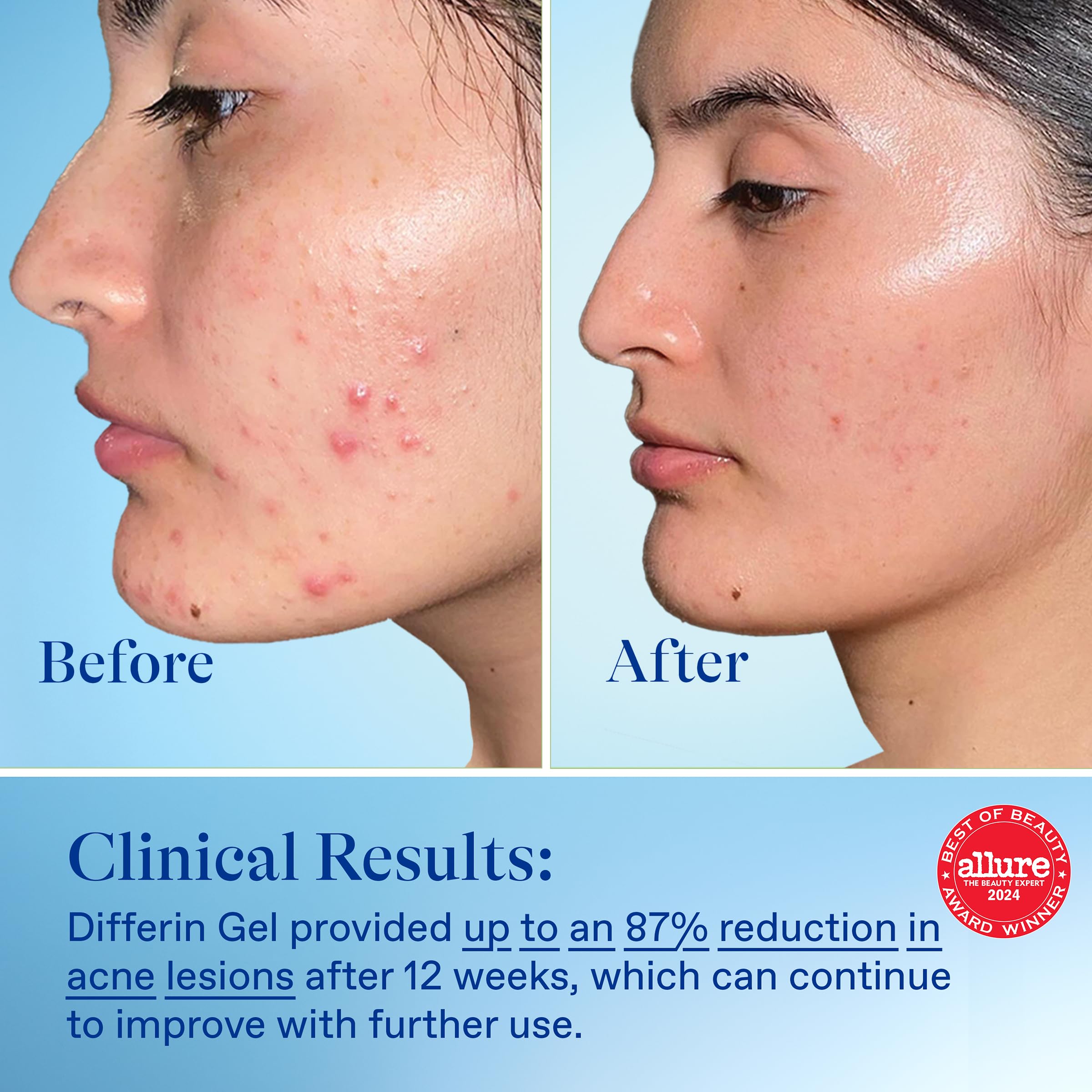 Foto 7 | Gel Para Tratamiento Del Acné Differin 0,1% De Adapaleno, 15 G, Suministro Para 30 Días - Venta Internacional.