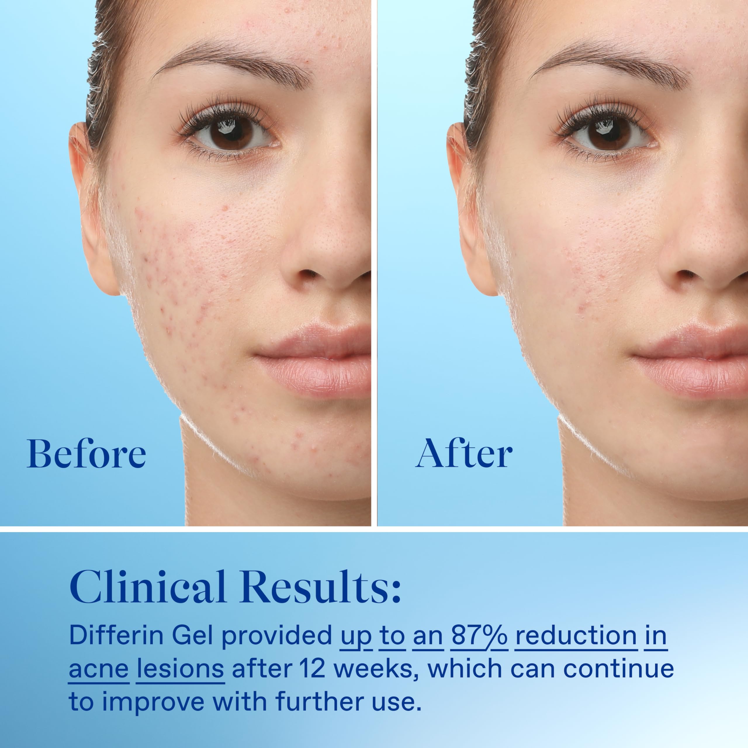 Foto 6 | Gel Para Tratamiento Del Acné Differin 0,1% De Adapaleno, 45 G X 2 - 180 Días - Venta Internacional.
