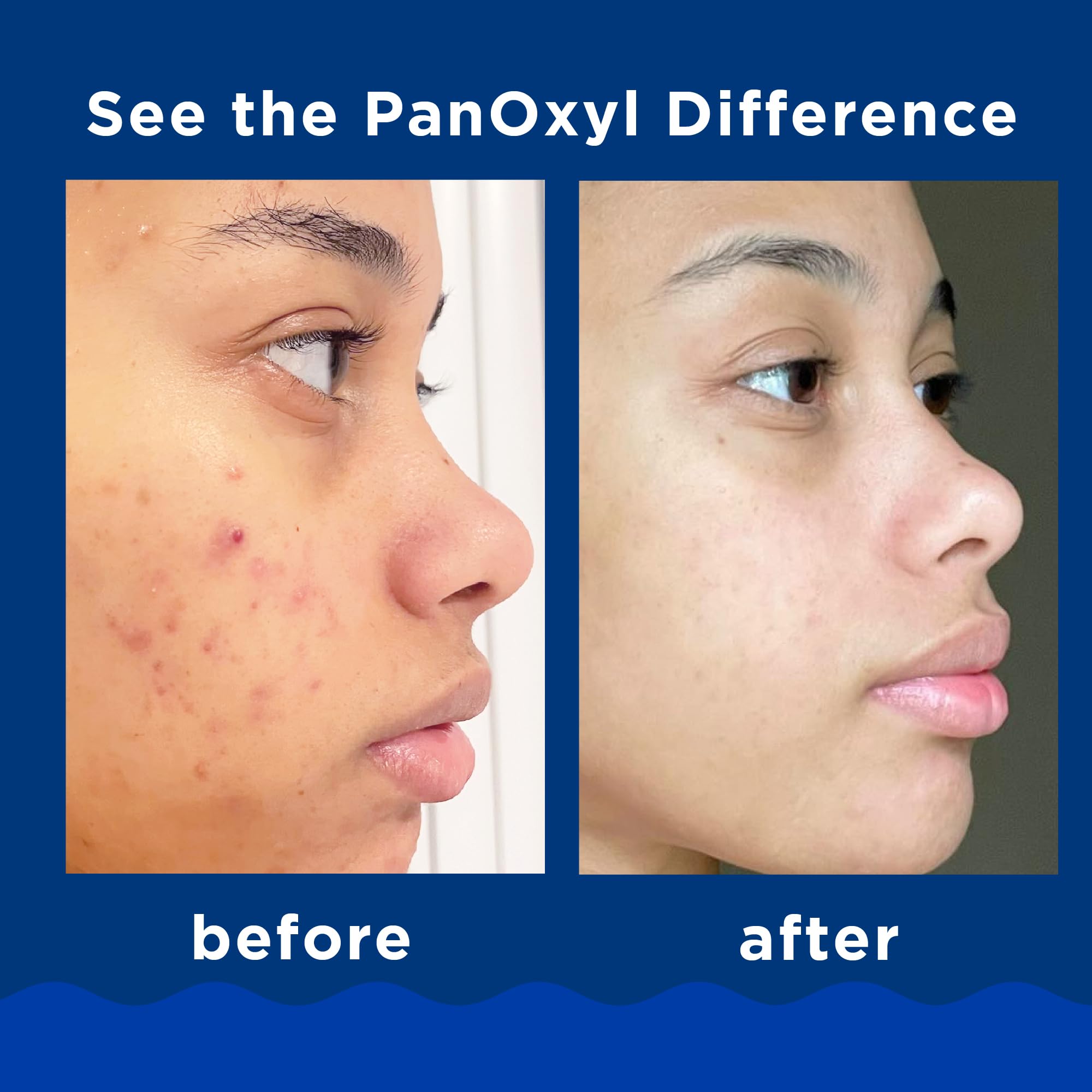 Foto 4 pulgar | Jabón Facial Panoxyl, Jabón Espumoso Para El Acné, Peróxido De Benzoilo Al 10%, 165 Ml - Venta Internacional.