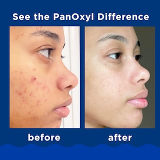 Foto 3 | Jabón Facial Panoxyl, Jabón Espumoso Para El Acné, Peróxido De Benzoilo Al 10%, 165 Ml - Venta Internacional.