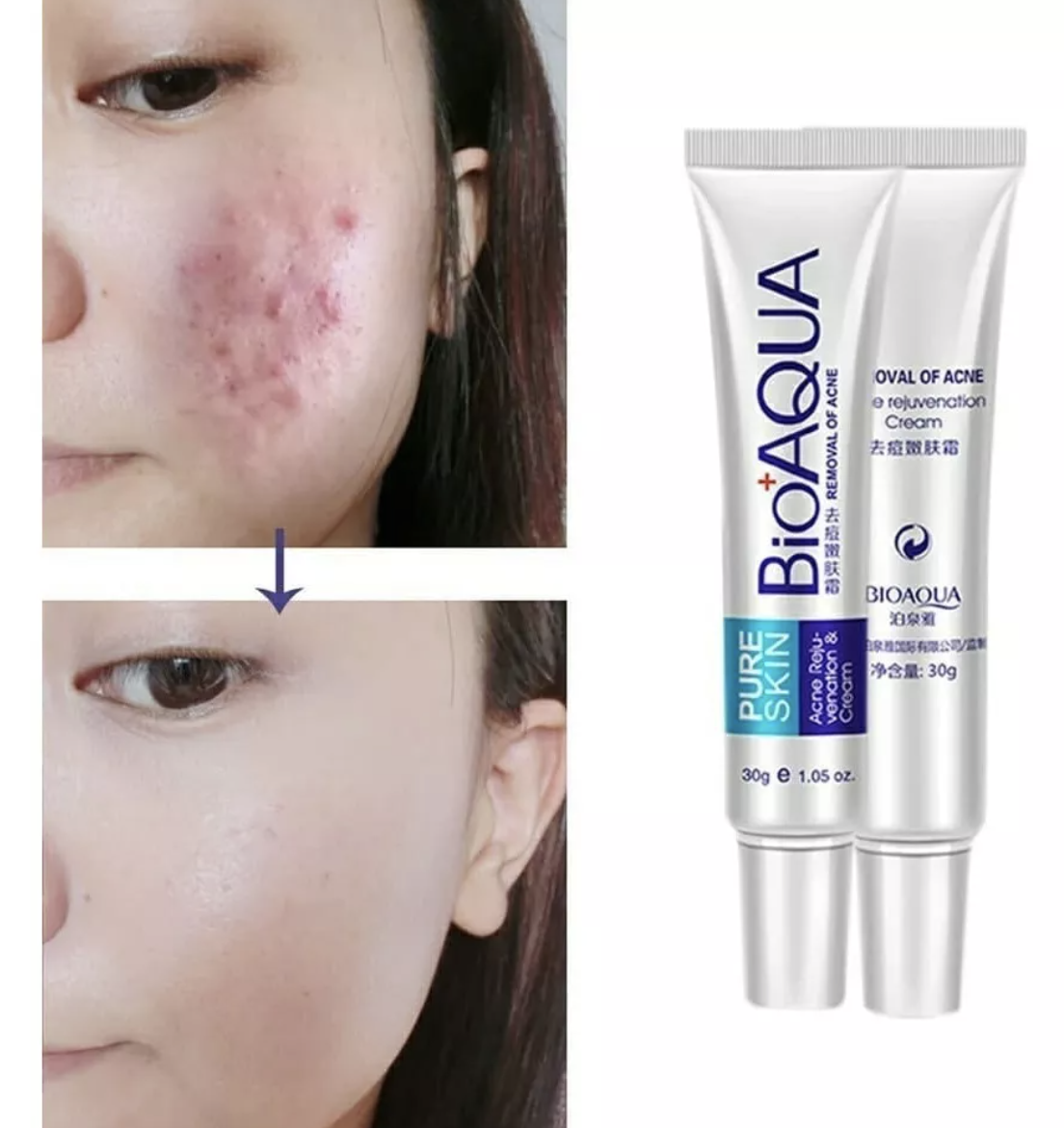 Foto 2 pulgar | Crema Anti Acne Bioaqua Pure Skin Cicatrices Control Grasa