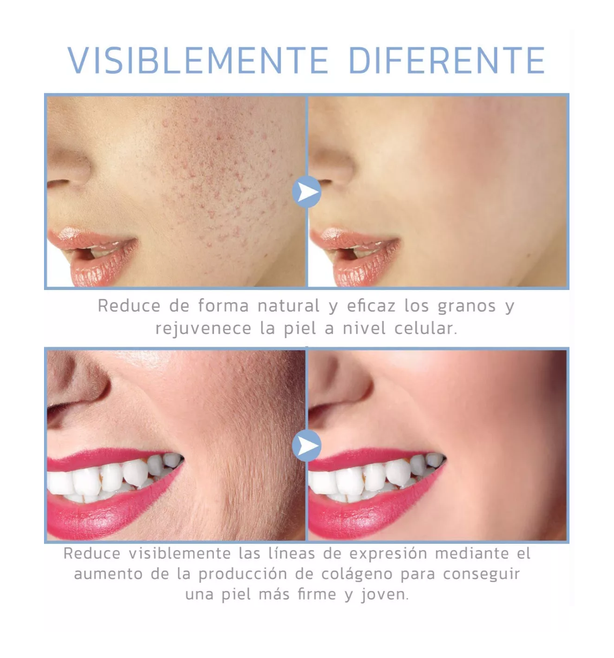 Foto 4 | Dispositivo de Belleza de Alta Frecuencia para el Rostro Dorado y Blanco