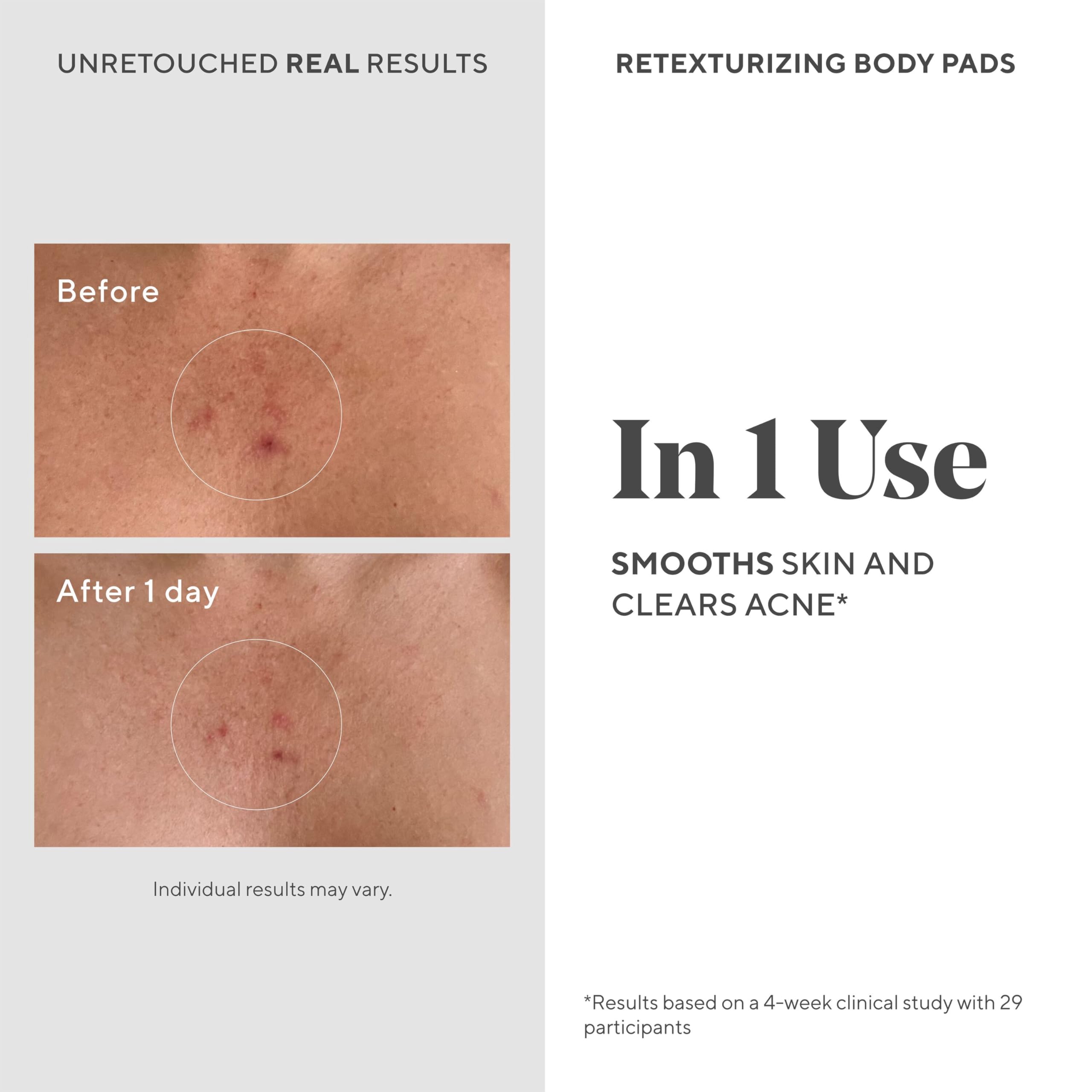 Foto 4 pulgar | Almohadillas Faciales Y Corporales Murad Acne Retexturizing 45 Almohadillas - Venta Internacional.