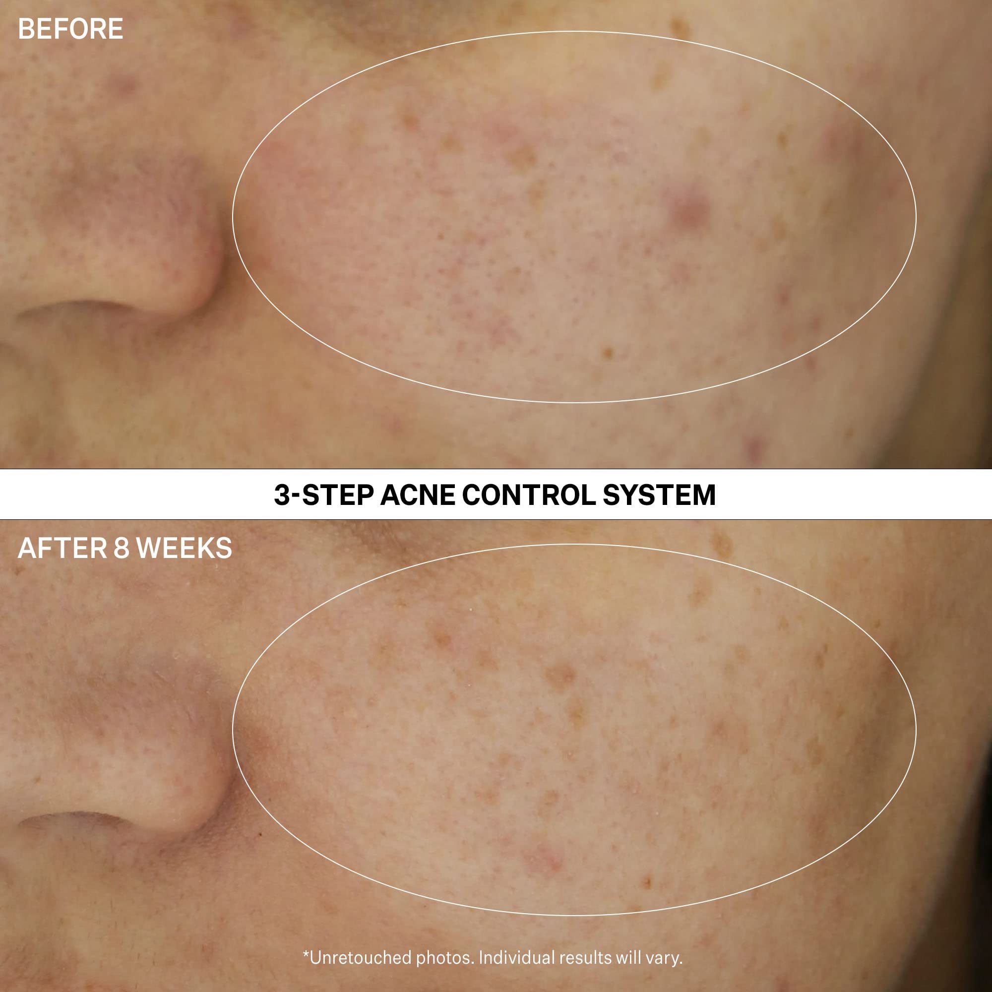 Foto 3 | Set de Control Tratamiento Acné Strivectin Multi-action Clear 30 Day - Venta Internacional