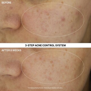 Foto 3 | Set de Control Tratamiento Acné Strivectin Multi-action Clear 30 Day - Venta Internacional