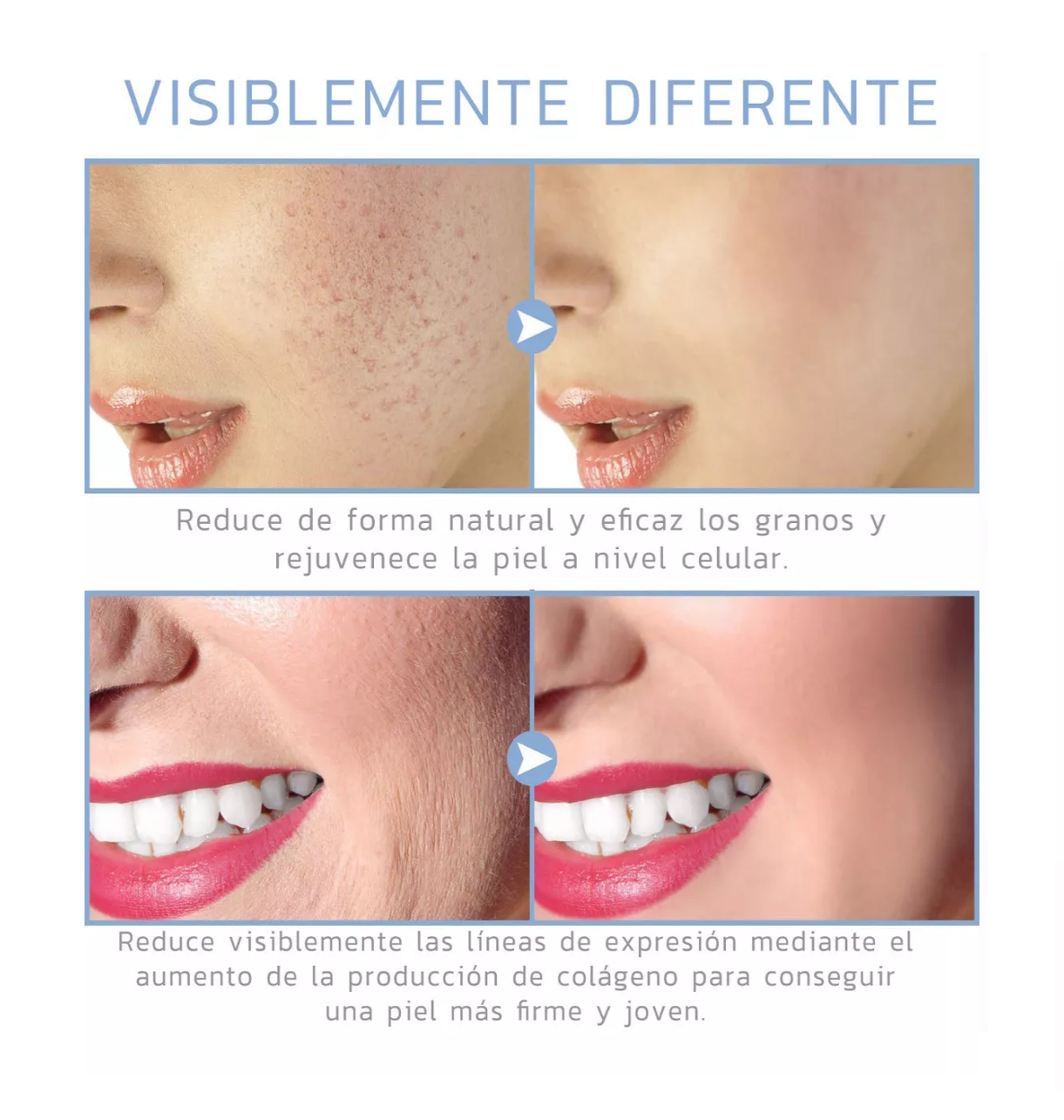 Foto 5 pulgar | Dispositivo De Belleza De Alta Frecuencia Para El Rostro Dorado/blanco Belug