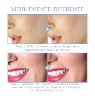 Foto 4 | Dispositivo De Belleza De Alta Frecuencia Para El Rostro Dorado/blanco Belug
