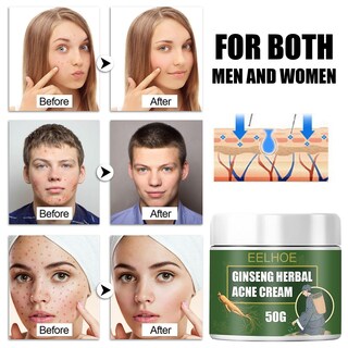 Foto 5 | Crema Para El Acné Huoguo Ginseng Herbal Desalt Reparadora De Cicatrices 10-50 G - Venta Internacional.