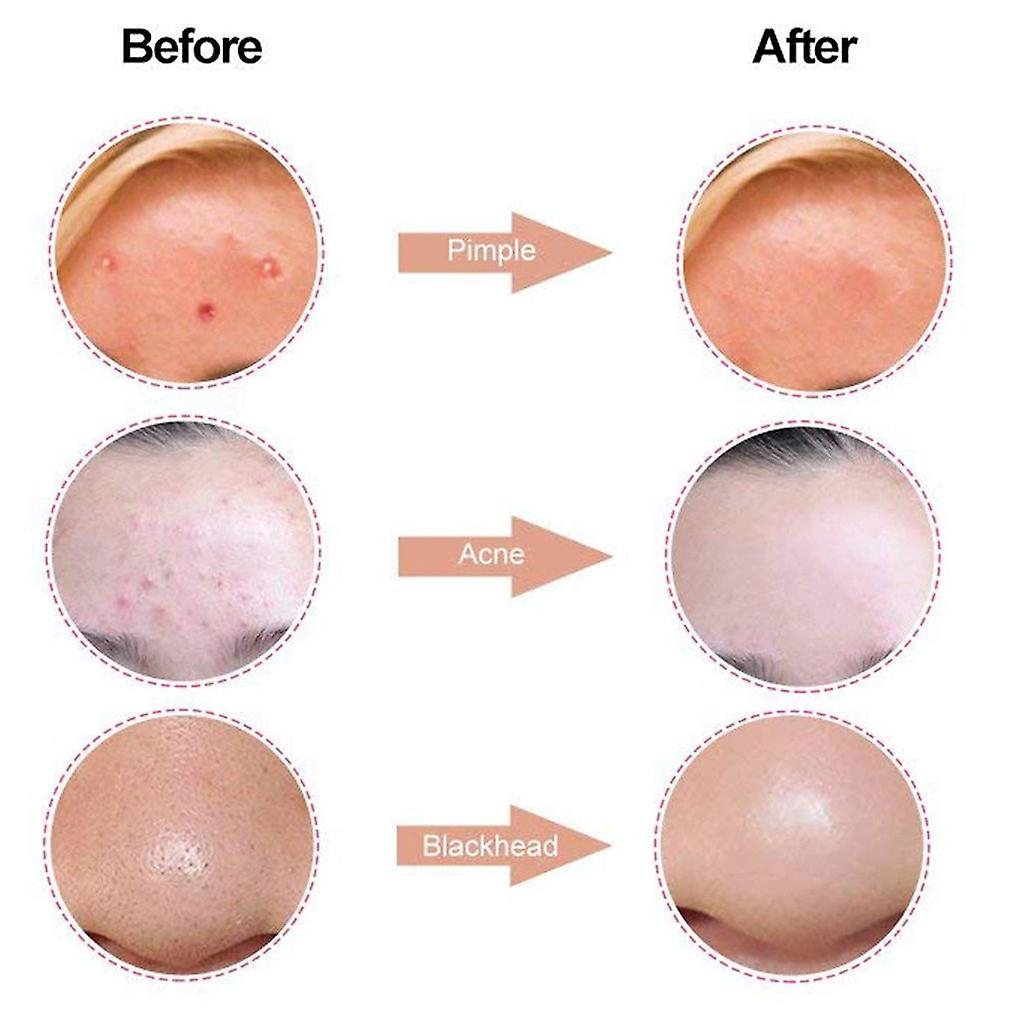 Foto 5 pulgar | Juego De Removedores De Espinillas Para Acné Facial De Acero Inoxidable  7 Piezas - Venta Internacional.