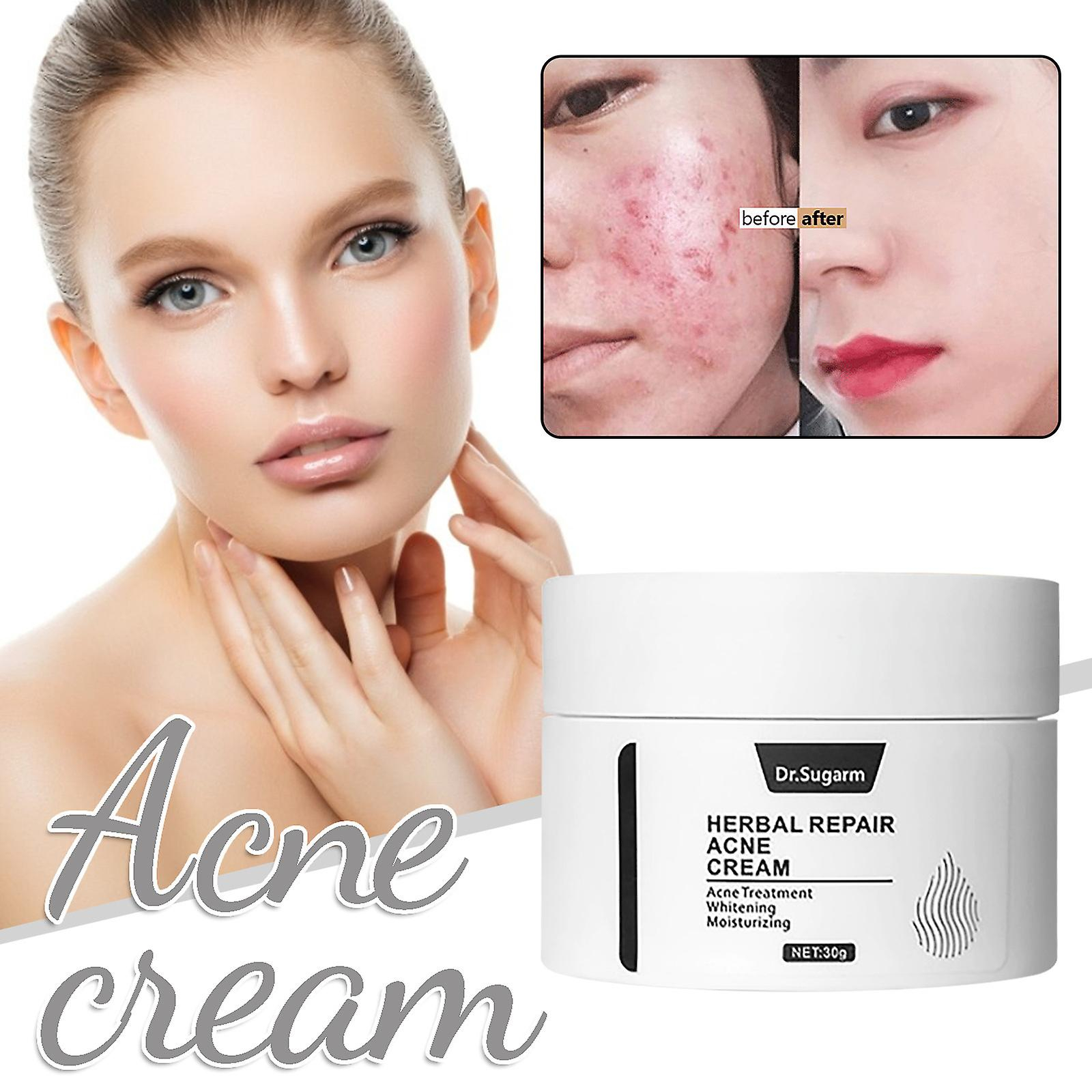 Foto 3 pulgar | Crema De Eliminación De Cicatrices De Acné Huoguo Para Aceite Facial Y Agua Bala - Venta Internacional.